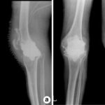 Static spacer migration with bone loss