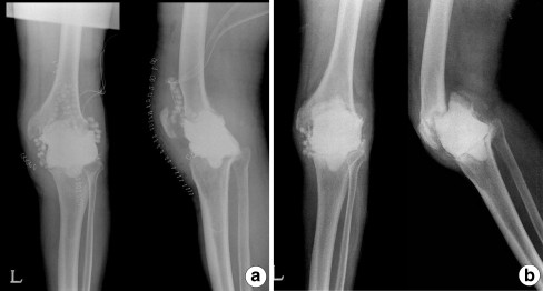 Static spacer migration with bone loss