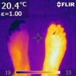 Infrared image of a cold left foot (25°C with 19°C toes) compared to a warm (33°C) right foot