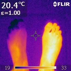 Infrared image of a cold left foot (25°C with 19°C toes) compared to a warm (33°C) right foot