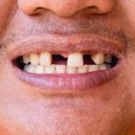 Smiling man with missing teeth