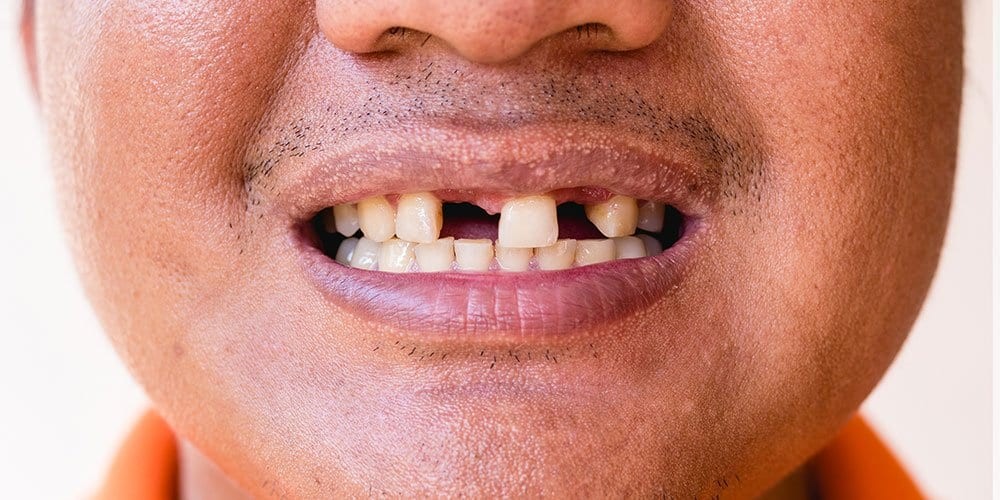 Smiling man with missing teeth