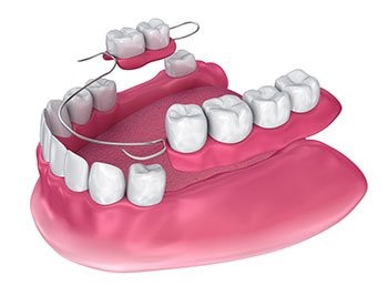 Illustration of partial denture replacing missing teeth