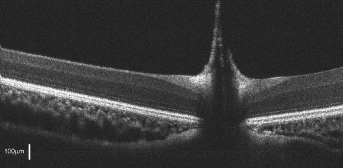 OCT image crossing the pecten at the ONH of the left eye of a broad-winged hawk showing the pecten protruding into the vitreous.