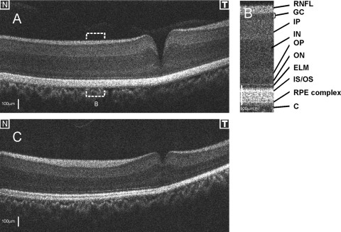 Composite RNFL thickness map of the broad-winged hawk retina showing the distribution of the retinal nerve fiber layer around the deep and shallow foveae.