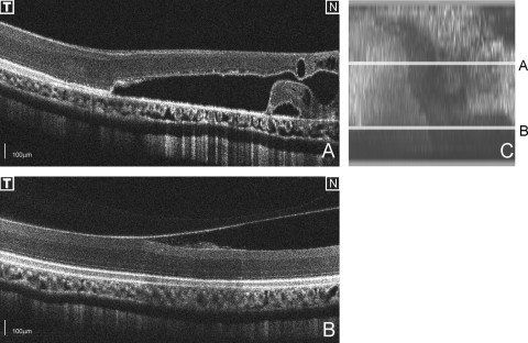 OCT images of the retina of a broad-winged hawk's right eye showing traumatic retinal injury including retinal detachment and intraretinal cysts.