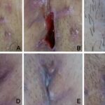 Mesalt dressing for wound care