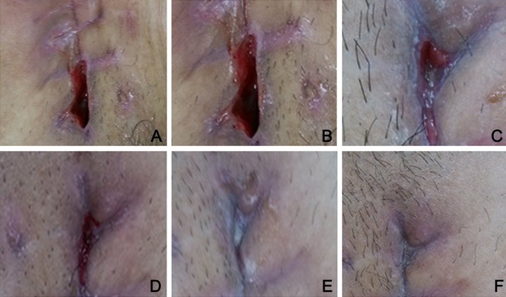 Mesalt dressing for wound care